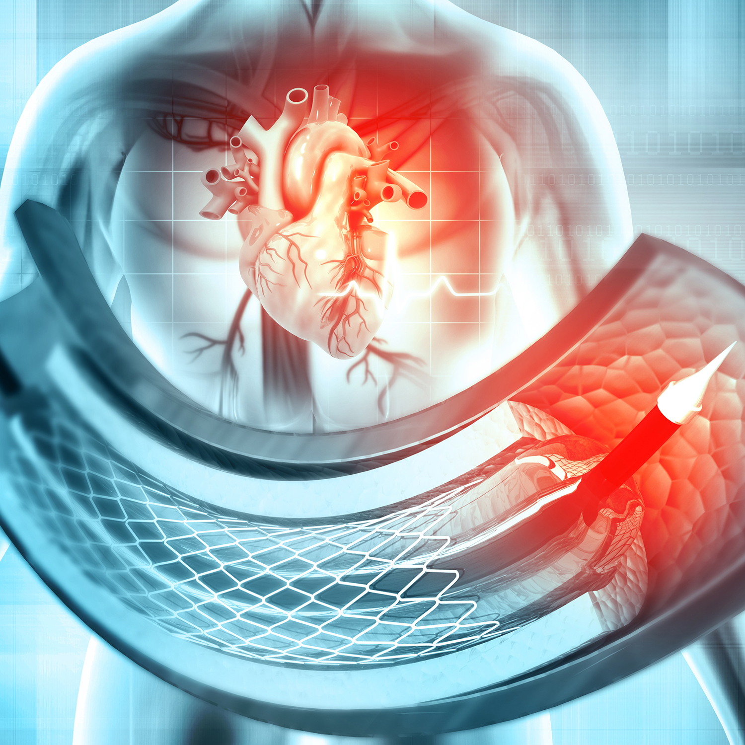 Stent and catheter for implantation into blood vessels. 3d illustration