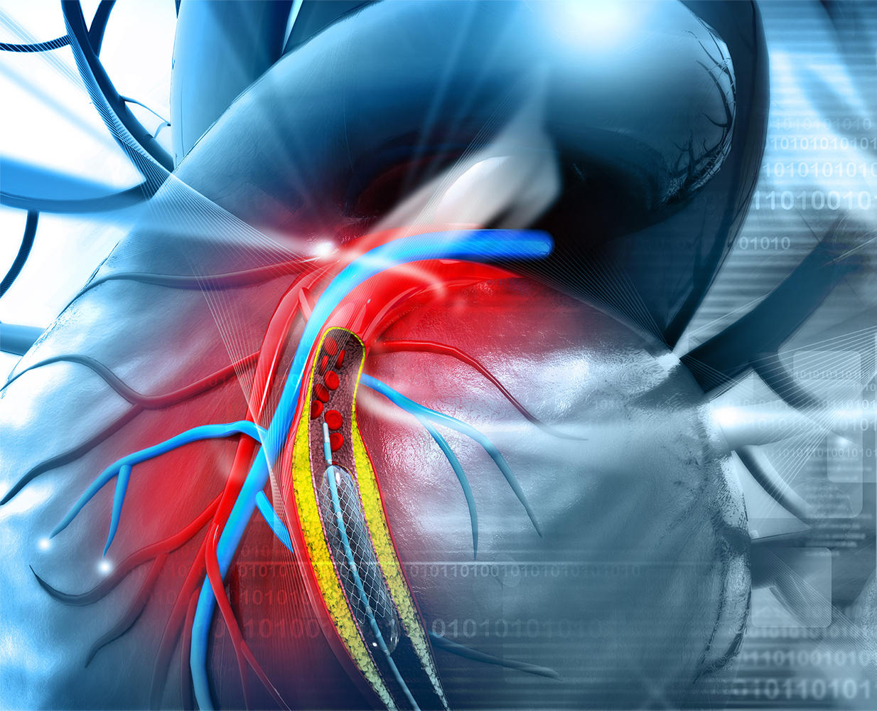 Stent angioplasty procedure with placing a balloon